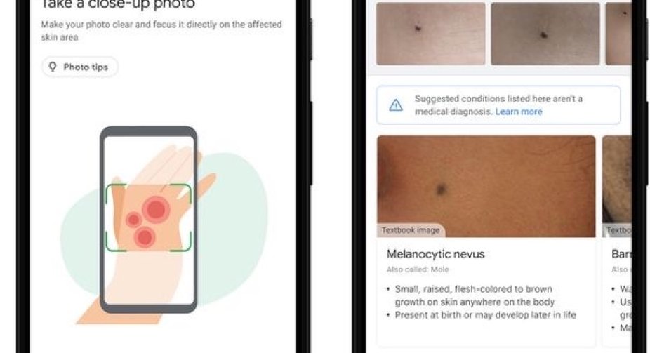 Google AI tool can help patients identify skin conditions
