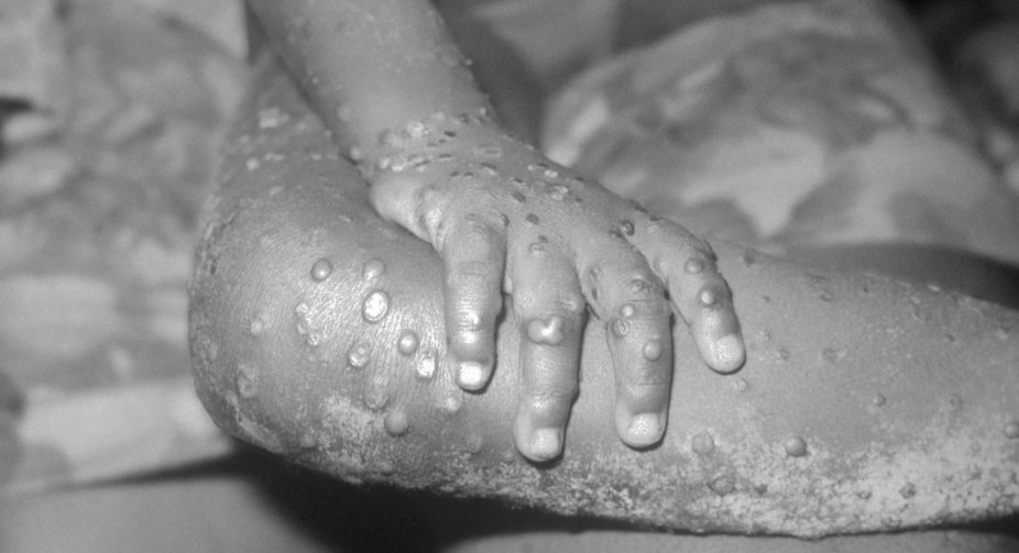 The first case of monkeypox has been reported in Israel   